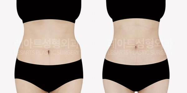 abdominal_liposuction_01_thumbnail_250918