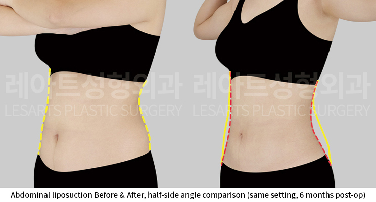 abdominal_liposuction_02_05_250918