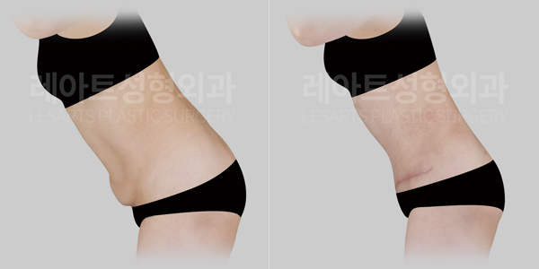 abdominoplasty_01_thumbnail_250912