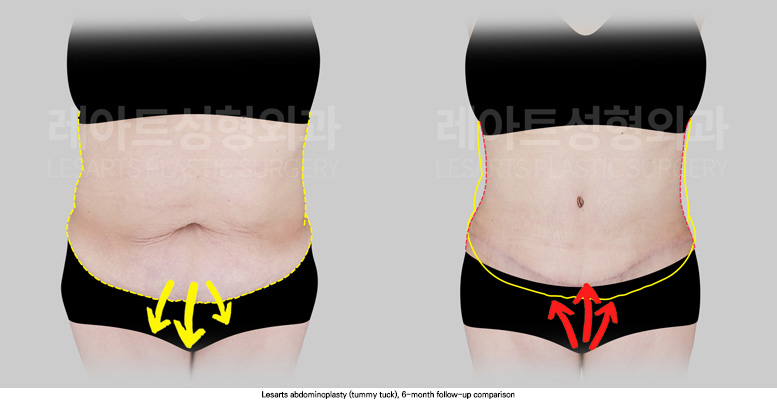abdominoplasty_02_03_250909