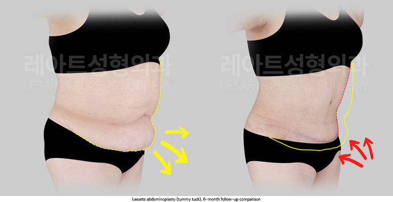 abdominoplasty_02_04_250909