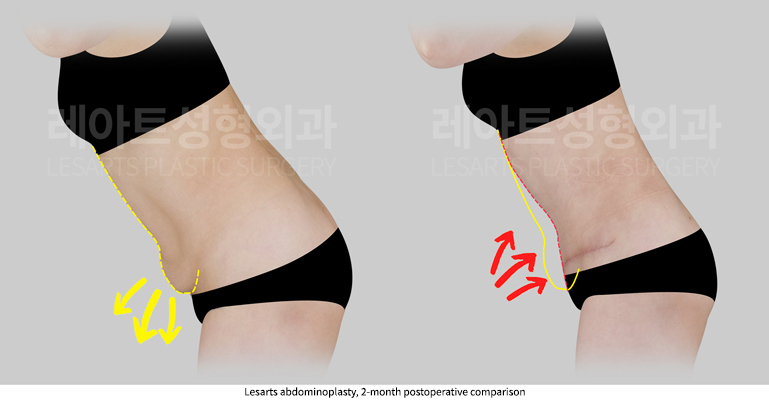 abdominoplasty_02_04_250912