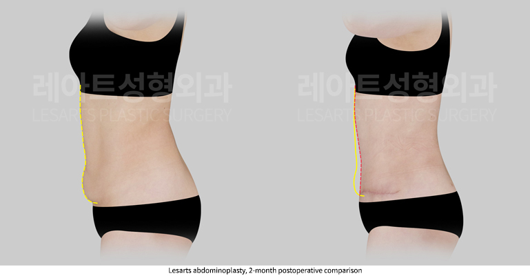 abdominoplasty_02_06_250912