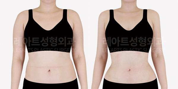 arm_liposuction_01_thumbnail_250911