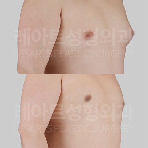 Gynecomastia :What changes can you expect 2 months after gynecomastia surgery?
