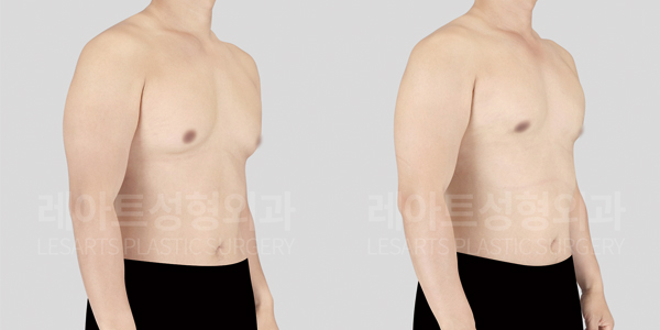 gynecomastia_01_thumbnail_250902
