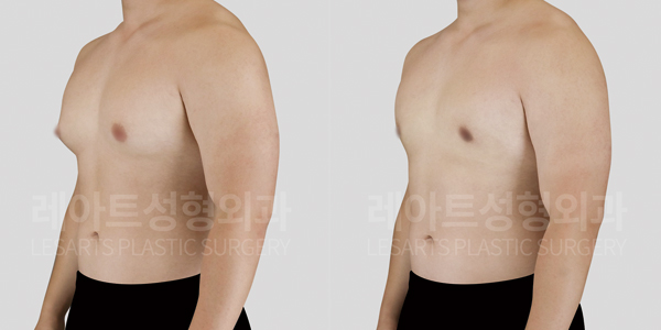 gynecomastia_01_thumbnail_250925