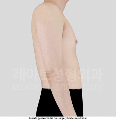 gynecomastia_02_02_250911