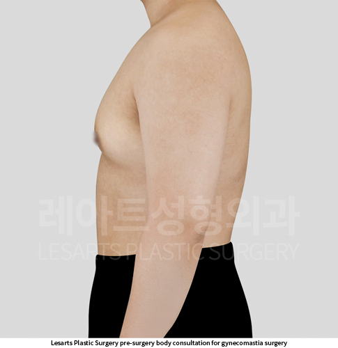 gynecomastia_02_02_250918