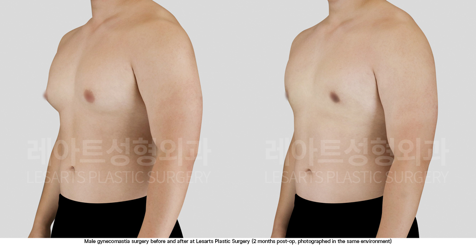 gynecomastia_02_03_250925