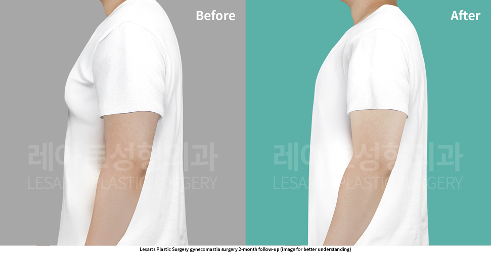 gynecomastia_02_06_250918