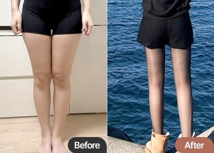 Thigh Liposuction in Korea – 2-Month Recovery Review with Daily Comfort at Lesarts Plastic Surgery