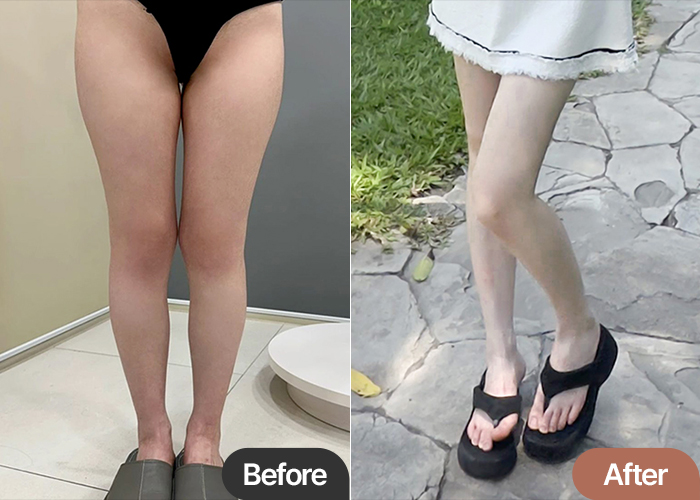 Thigh Liposuction & Hip Fat Transfer Review in Korea -Filled Hip Dips, Boosted Confidence