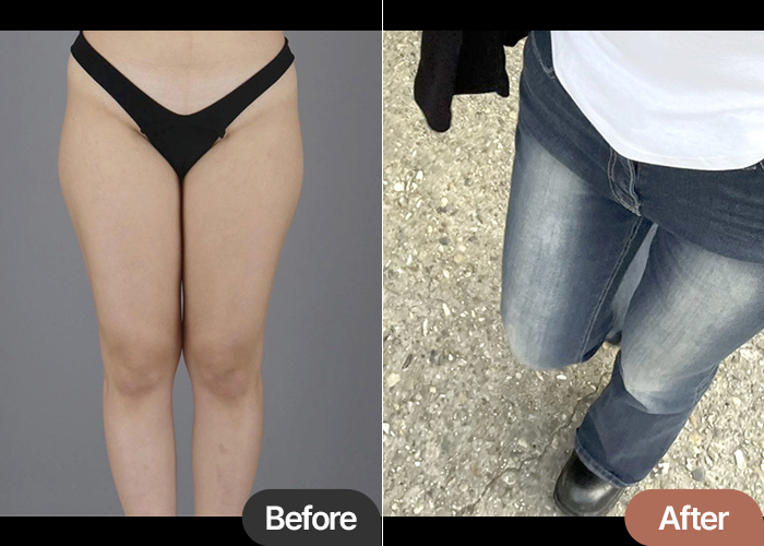 Thigh Liposuction in Korea – Real Review with High Satisfaction at Lesarts Plastic Surgery