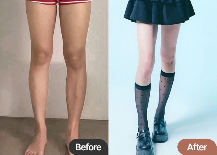 Thigh Liposuction in Korea – Natural Slim Legs After 5–6 Months at Lesarts Plastic Surgery