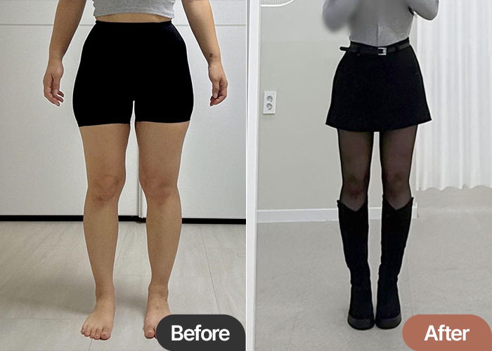 Thigh Liposuction and Hip Line Contouring: 3-Month Post-Op Success | Lesarts