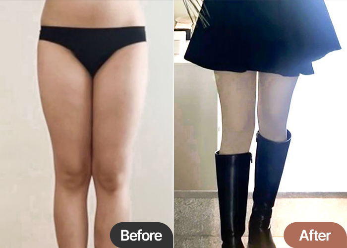 Thigh Liposuction in Korea – 1000% Satisfaction and Happier Every Day