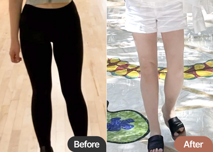 UnniECSZII thigh and calf liposuction before & after leg line transformation – Best Liposuction Clinic in Korea Lesarts