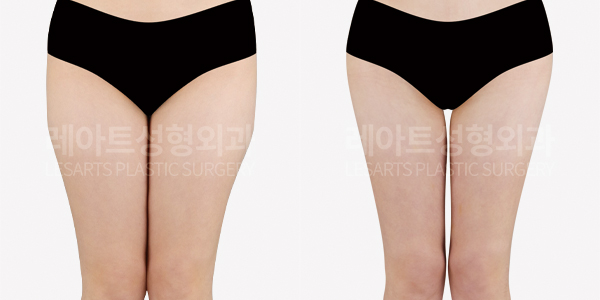 thigh_liposuction_01_thumbnail_250902