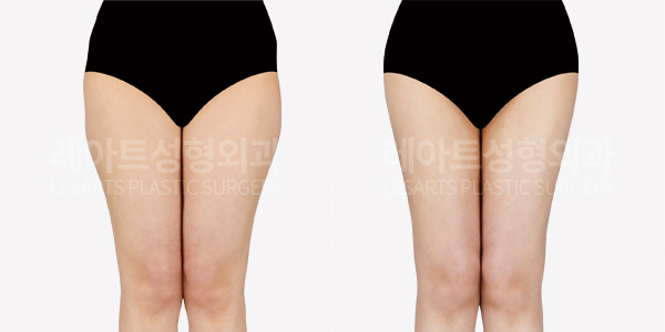 thigh_liposuction_01_thumbnail_250904