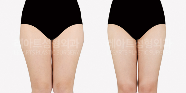 thigh_liposuction_01_thumbnail_250922