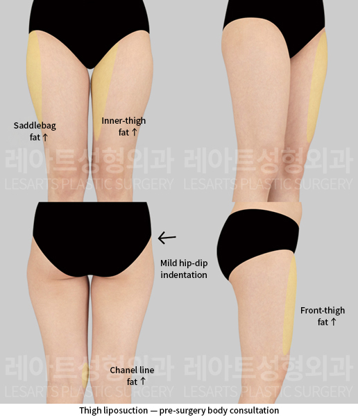 thigh_liposuction_02_01_250915