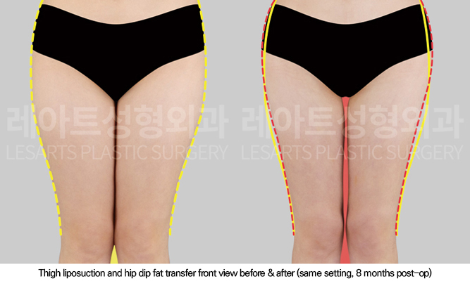 thigh_liposuction_02_02_250902
