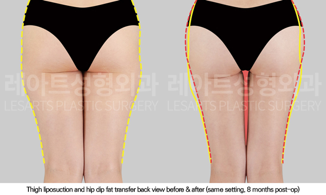 thigh_liposuction_02_03_250902