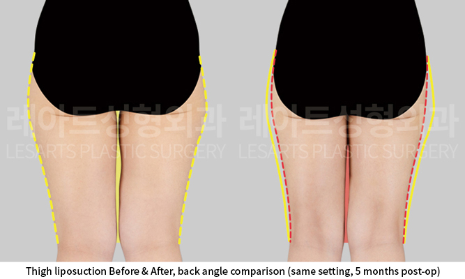 thigh_liposuction_02_03_250922