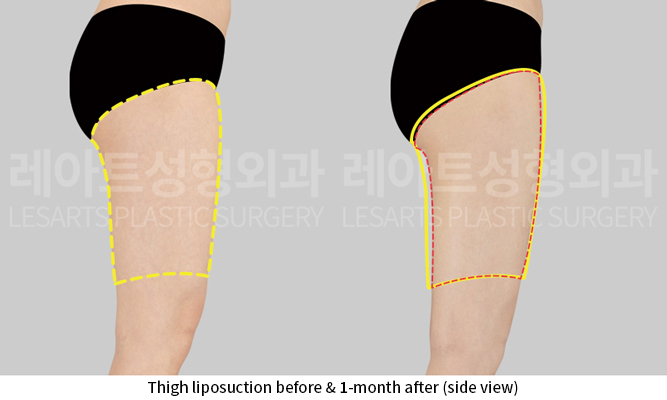 thigh_liposuction_02_04_250915