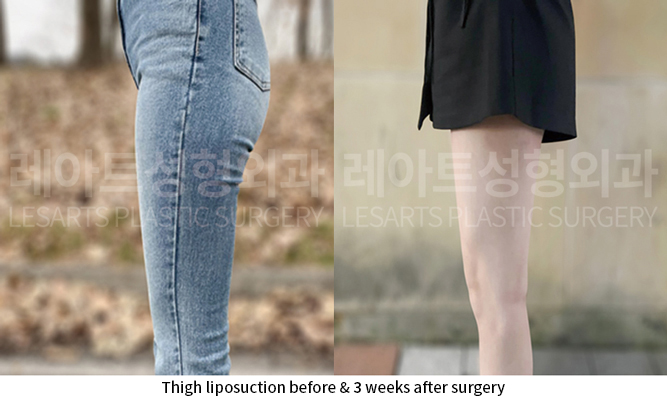 thigh_liposuction_02_07_250915
