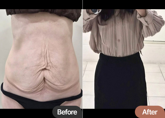 Tummy Tuck in Korea After C-Section – Real Long-Term Recovery Review at Lesarts Plastic Surgery