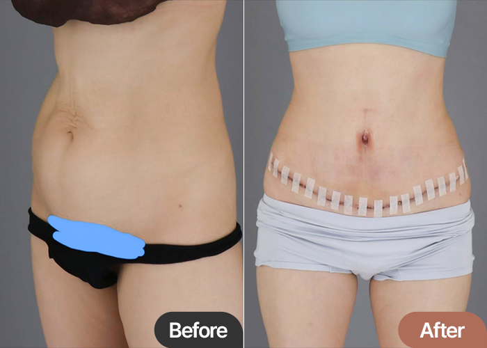 Tummy Tuck Review in Korea After Weight Loss – Skin Tightness & Better Fit at Lesarts Plastic Surgery