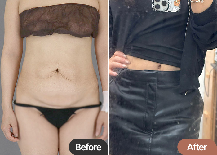 Amazing 5-Month Tummy Tuck & Hip Fat Transfer Results at Lesarts