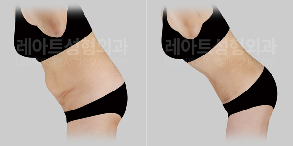 tummy_tuck_01_thumbnail_250916