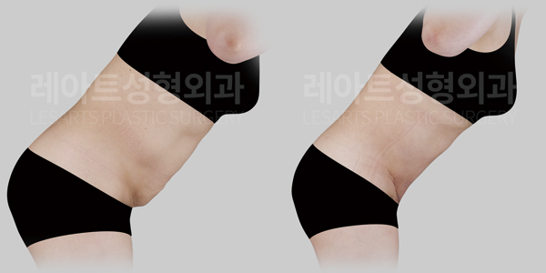 tummy_tuck_01_thumbnail_250924