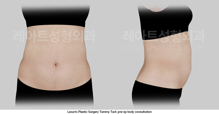 tummy_tuck_02_01_250924