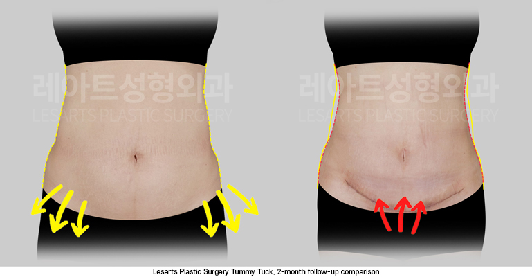 tummy_tuck_02_03_250924