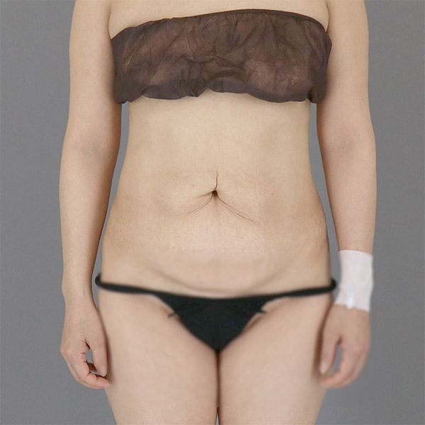 Tummy tuck and hip fat transfer before and after 5 months results by Dr. Kukhan Lee at Lesarts Plastic Surgery