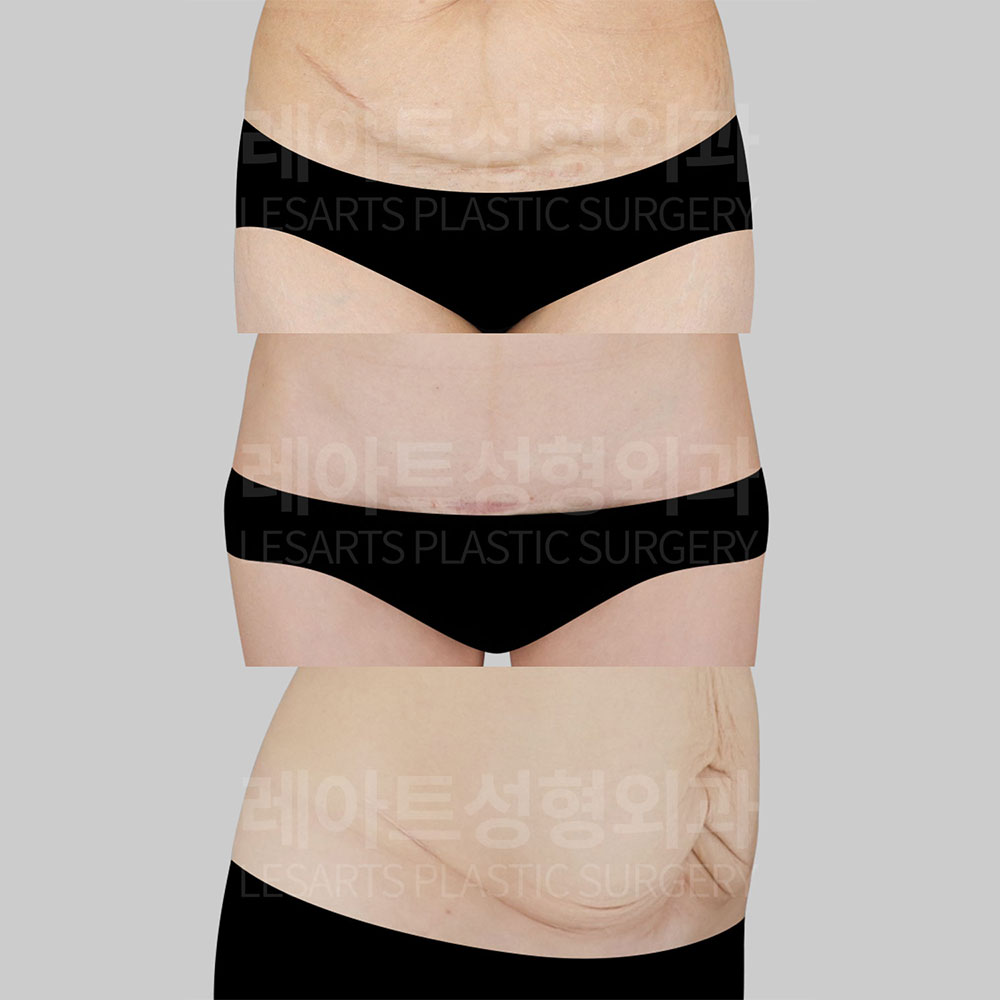 Abdominoplasty : Why do cesarean section scars feel especially concerning?