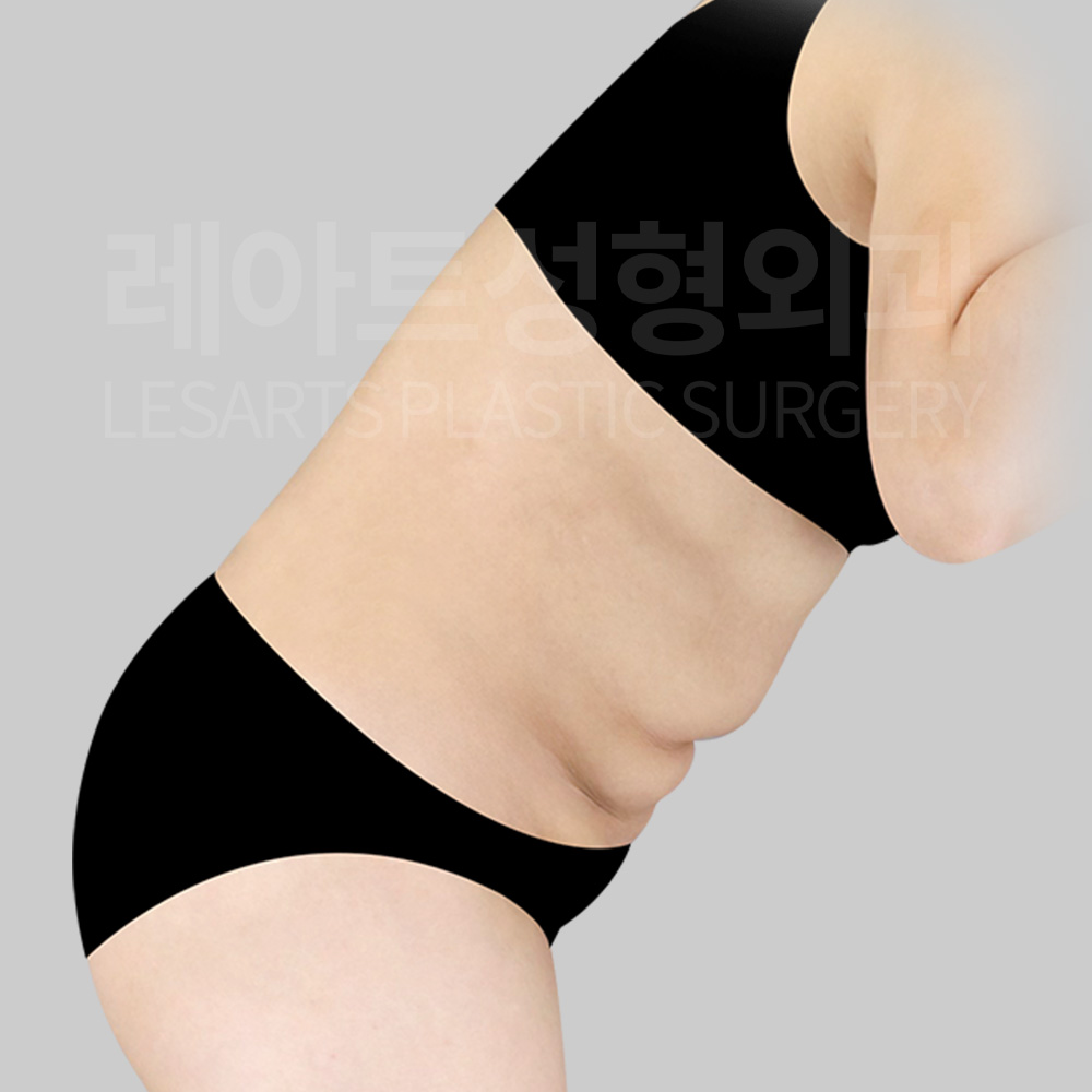 1-1.tummy-tuck-26386-before