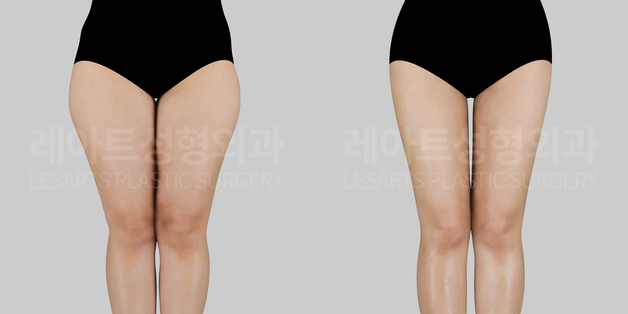 [Thigh liposuction]Rapid weight gain caused by external factors (steroids, hormone therapy). What should you do?
