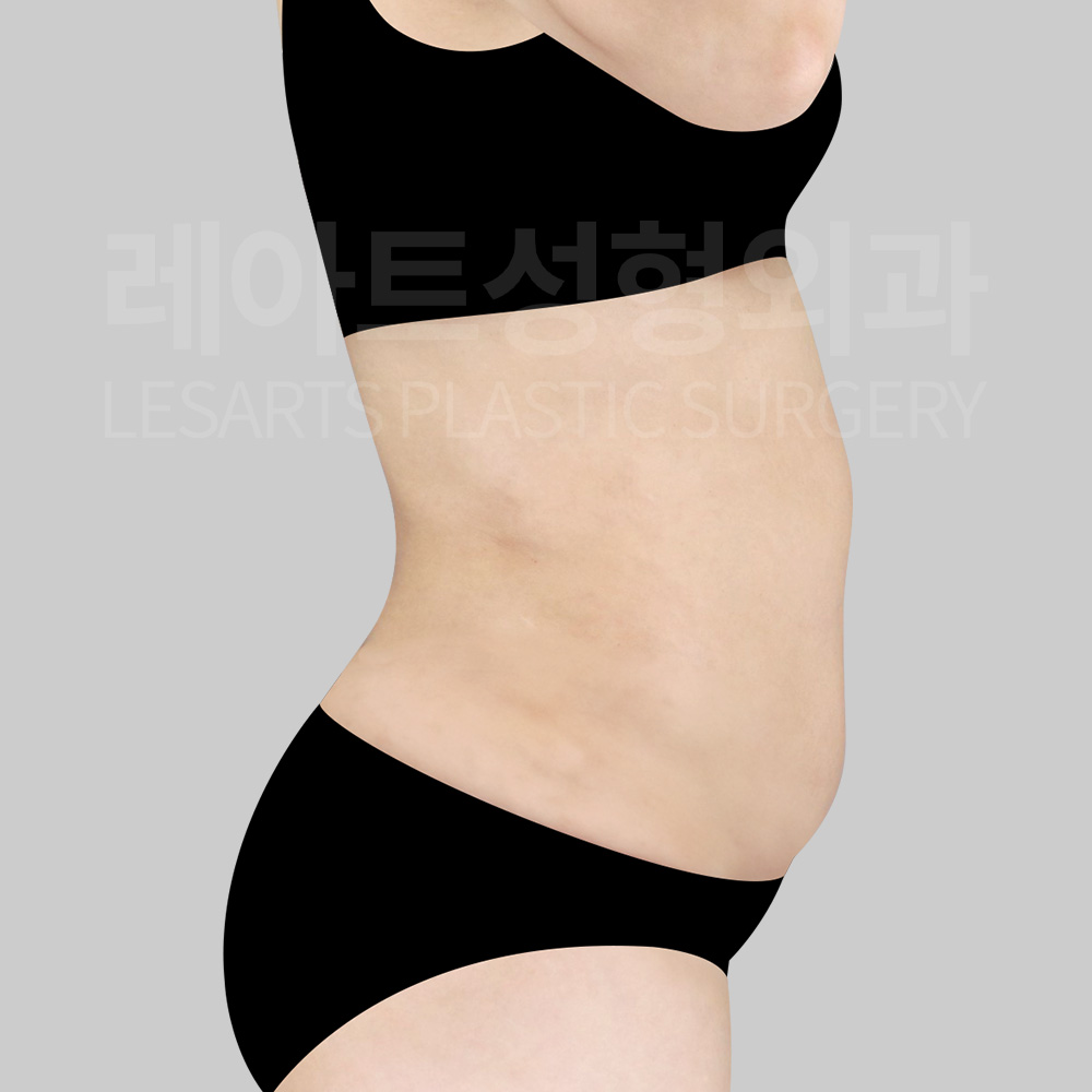 1-3.tummy-tuck-26386-before