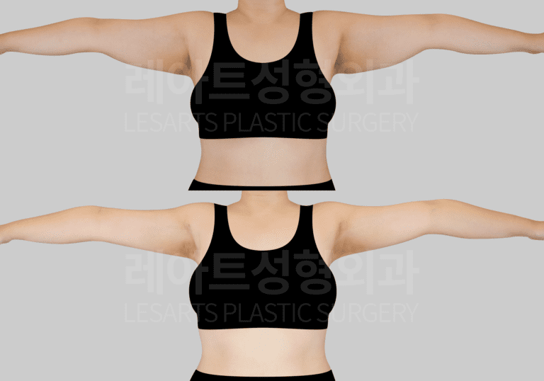 2-1.arm_liposuction_29734_bna