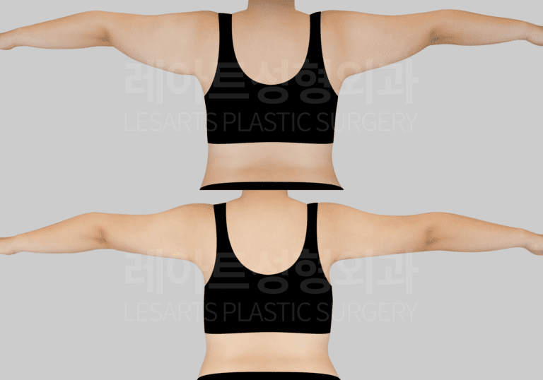 2-2.arm_liposuction_29734_bna