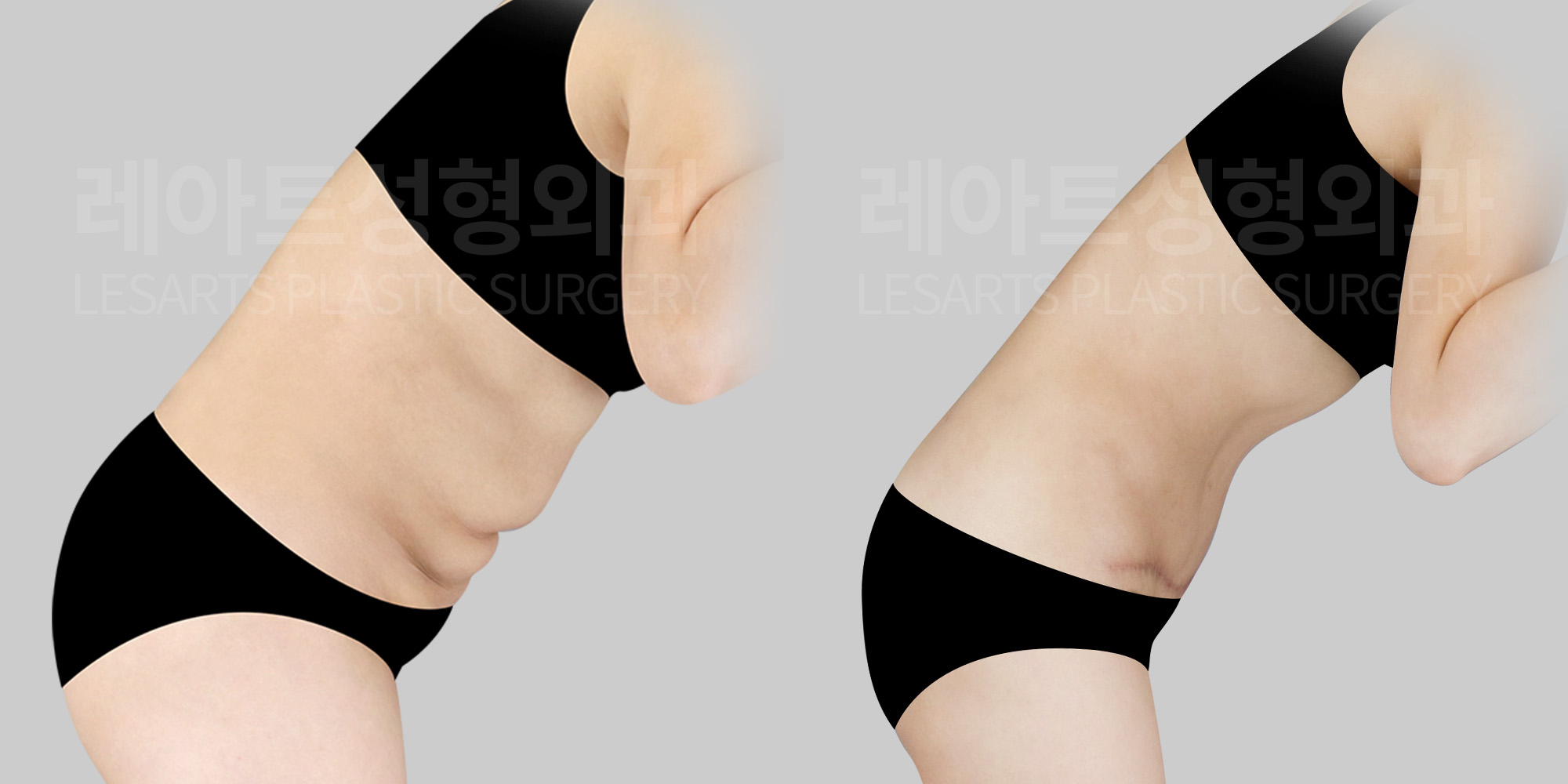 tummy-tuck-revision-before-and-after