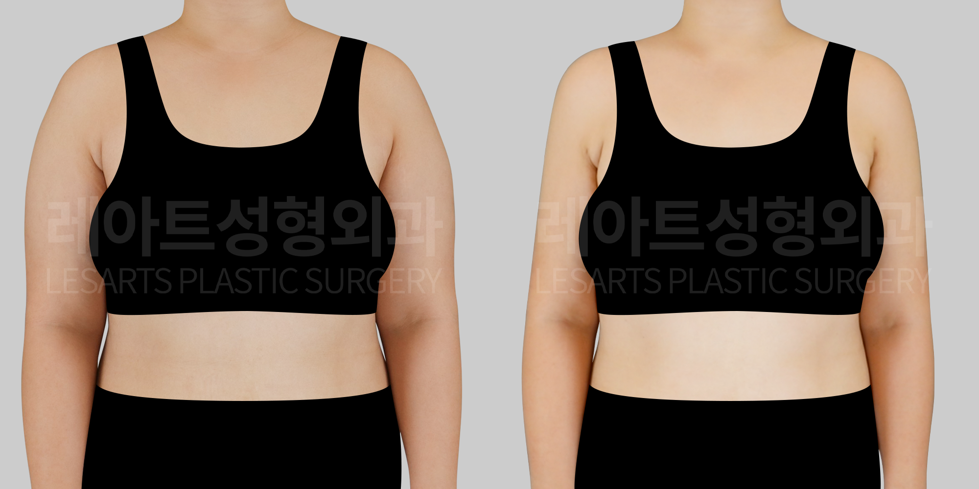 [Arm liposuction]Can changing just the arms make the entire frame look smaller?