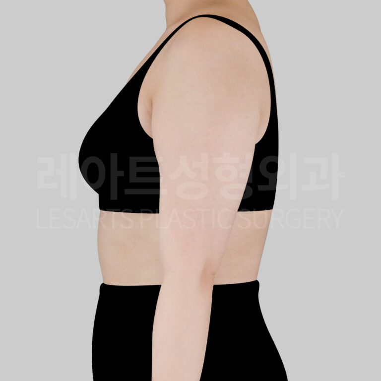 4.arm-liposuction-30802-before-side