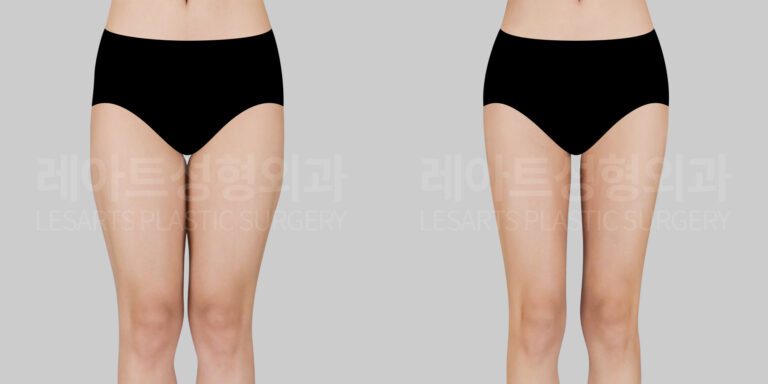 thigh-liposuction-before-and-after-30227