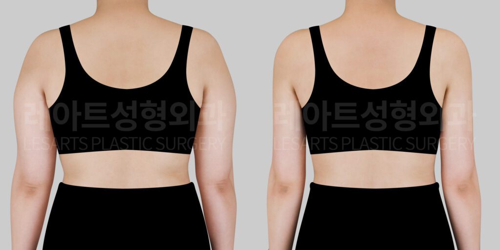 arm-liposuction-before-and-after-30802